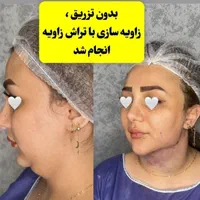 تزریق چربی فیلربادی تزریق ژل در مطب پزشک|خدمات آرایشگری و زیبایی|کرمانشاه, |دیوار