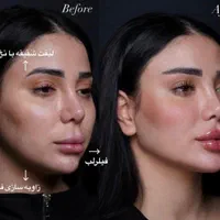 ساکشن شکم و‌پهلو بلفارو و جراحی|خدمات آرایشگری و زیبایی|مشهد, هفت تیر (حافظ)|دیوار