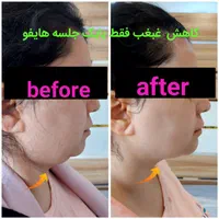 هایفوتراپی،لیفت وجوانسازی صورت،رفع غبغب|خدمات آرایشگری و زیبایی|تهران, ظفر|دیوار