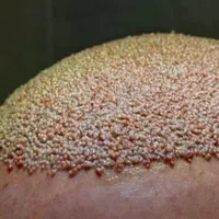کاشت مو و ابرو تیم شیرازی در قزوین ، جشنواره اقساط|خدمات آرایشگری و زیبایی|قزوین, |دیوار
