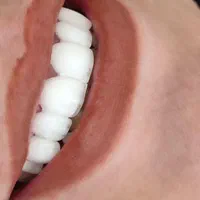 دندان کامپوزیت روکش