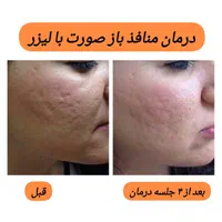 کیوسوئیچ، لیزر موهای زائد، هایفو، جوانسازی|خدمات آرایشگری و زیبایی|آبادان, |دیوار