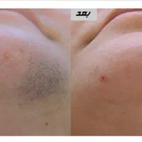 لیزر موهای زائد با دستگاه اشنایدر پلاس آلمانی|خدمات آرایشگری و زیبایی|مشهد, مهدی آباد|دیوار