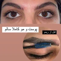 ریمووانواع تتوهای بدن،لب،وچشم ،ابرو|خدمات آرایشگری و زیبایی|رشت, حمیدیان|دیوار