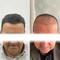 کاشت مو کاشت ابرو کاشت ریش تارکوب