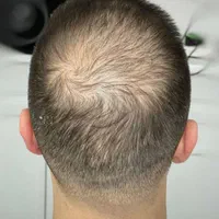 کلینیک تخصصی اسکالپ خداحافظ کم پشتی موجایگزین کاشت