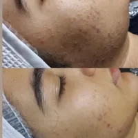 پاکسازی پوست حرفه ای خانم و اقایون در کلینیک|خدمات آرایشگری و زیبایی|اراک, |دیوار