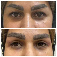 بلفاروپلاستی