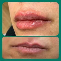 تزریق ژل و فیلر و بوتاکس و نخ لیفت و پی آرپی و ...|خدمات آرایشگری و زیبایی|همدان, |دیوار