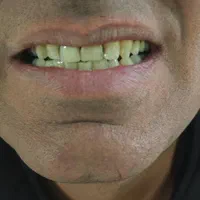 دندان مصنوعی بدون سقف، فلکسیبل، جایگزین ایمپلنت|خدمات آرایشگری و زیبایی|تهران, نظام‌آباد|دیوار