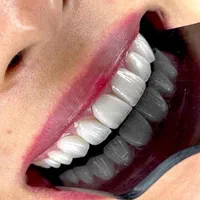 کامپوزیت/لمینت/روکش/پالیش|خدمات آرایشگری و زیبایی|تهران, طرشت|دیوار