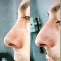 جراحی زیبایی بینی فقط با 22 میلیون|خدمات آرایشگری و زیبایی|قائم‌شهر, |دیوار