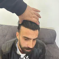 کاشت مو ابرو ریش کلینیک تخصصی اکسیر