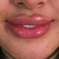 جشنواره نوروزمدل ژل وبوتاکس هایفو تراپی مزوتراپی ‌|خدمات آرایشگری و زیبایی|تهران, تهرانپارس شرقی|دیوار