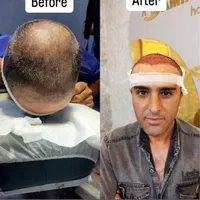 کاشت مو و ابرو و انجام بوتاکس و مزوتراپی و PRP|خدمات آرایشگری و زیبایی|قزوین, |دیوار