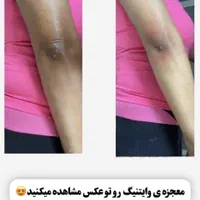 روشن شدن زیر بغل و زانو و آرنج با لیزر کیوسویچ|خدمات آرایشگری و زیبایی|کرج, گوهردشت|دیوار