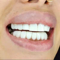 کامپوزیت زیبایی دندانپزشکی|خدمات آرایشگری و زیبایی|یاسوج, |دیوار