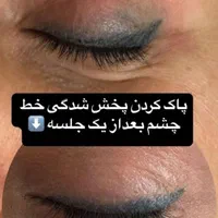 پاک کردن تتو ویژه اقایان وبانوان باجدیدترین دستگاه|خدمات آرایشگری و زیبایی|اهواز, نادری|دیوار