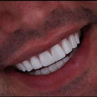 کامپوزیت دندان با کیفیت و زیبا