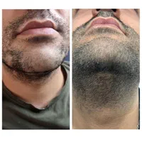 بوتاکس،فیلر،لیزر خانم و آقا،مزو،فیشال|خدمات آرایشگری و زیبایی|ری, دیلمان|دیوار