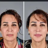 لیفت نخ معجزه جوانی و لیفتینگ صورت بدون جراحی|خدمات آرایشگری و زیبایی|شاهین‌شهر, فردوسی|دیوار