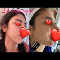 پاکسازی پوست فشیال لیزر پوست فیشیال|خدمات آرایشگری و زیبایی|شیراز, درکی|دیوار