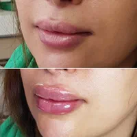 بوتاکس ژل فیلر مزوتراپی لیزر هایفو لیفت نخ در مطب|خدمات آرایشگری و زیبایی|اصفهان, مسجد مصلی|دیوار