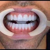 ( ایمپلنت بدون جراحی پانچ از ۶ تومن )|خدمات آرایشگری و زیبایی|اصفهان, سرچشمه|دیوار