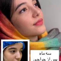 جراحی زیبائی بینی عمل بینی لیفت شقیقه پلک گوش غبغب|خدمات آرایشگری و زیبایی|اصفهان, مرداویج|دیوار