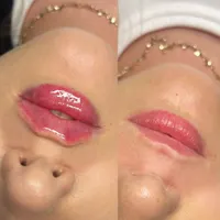 آنزیم ترکیبی بینی گوشتی،لیفت بینی،ژل لب،مزوتراپی|خدمات آرایشگری و زیبایی|تهران, سعادت‌آباد|دیوار