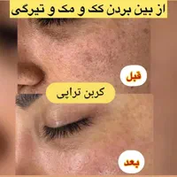 لیزر کیوسوئیچ رفع تیرگی صورت بیکینی و ریمو تاتو|خدمات آرایشگری و زیبایی|ارومیه, |دیوار