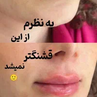 جشنواره تزریق ژل و بوتاکس،فیلرلب،مزو،هایفو،آنزیم|خدمات آرایشگری و زیبایی|کرج, عظیمیه|دیوار