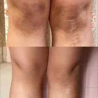 رفع تیرگی زیربغل بیکینی زانو