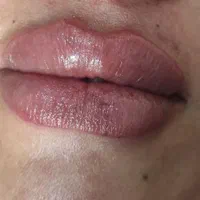 تزریق ژل،بوتاکس،خال برداری،مزوی مو و صورت|خدمات آرایشگری و زیبایی|بندر کنگان, |دیوار