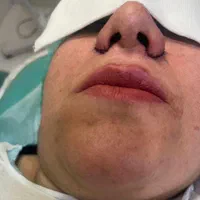 بلفاروپلاستی اتو پلاستی لیفت|خدمات آرایشگری و زیبایی|اهواز, نادری|دیوار