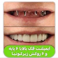 مرکز تخصصی ایمپلنت، مطب دندانپزشکی باقیمتی کم نظیر|خدمات آرایشگری و زیبایی|شیراز, قصرالدشت|دیوار