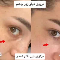 مرکز زیبایی دکتر اسدی (بوتاکس فیلر هایفو مزوتراپی)|خدمات آرایشگری و زیبایی|تهران, نیاوران|دیوار