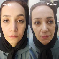 بلفاروپلاستی ،نخ سوپر لیفت تمامی خدمات بیوتی|خدمات آرایشگری و زیبایی|اصفهان, شهشهان|دیوار
