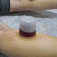 حجامت رفع مشکلات کبدی تیرگی پوست خستگی و غلظت خون