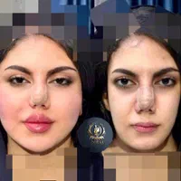 تزریق ژل و بوتاکس و مادلینگ خلیجی و هایفو درکلینیک|خدمات آرایشگری و زیبایی|کرمانشاه, |دیوار