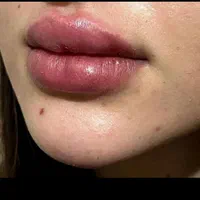 جشنواره پاییزه تزریق ژل وبوتاکس توسط پزشک متخصص|خدمات آرایشگری و زیبایی|بندرعباس, |دیوار