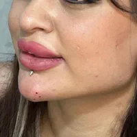 کلینیک تزریق ژل و بوتاکس انزیم پزشک|خدمات آرایشگری و زیبایی|کرج, گوهردشت|دیوار