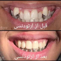 کامپوزیت،ارتودنسی،ایمپلنت