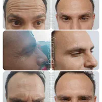 فیلرژل لب،ژل وبوتاکس تخصصی آقاوخانم در مطب پزشک|خدمات آرایشگری و زیبایی|شیراز, قصرالدشت|دیوار
