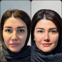 افر ویژه‌ی فیلر/بوتاکس/prpبا قیمت باورنکردنی|خدمات آرایشگری و زیبایی|تهران, دروازه شمیران|دیوار