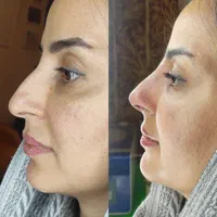 بوتاکس فیلر پی آر پی مزوتراپی زگیل تناسلی|خدمات آرایشگری و زیبایی|تبریز, |دیوار