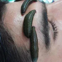حجامت درمانی ،زالو درمانی