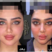تزریق تخصصی ژل ومادلینگ وبوتاکس وهایفو درکلینیک|خدمات آرایشگری و زیبایی|کرمانشاه, |دیوار