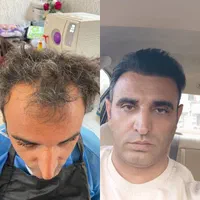 جشنواره کاشت مو