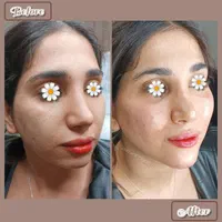فیلرژل لب،ژل وبوتاکس تخصصی آقاوخانم در مطب پزشک|خدمات آرایشگری و زیبایی|شیراز, قصرالدشت|دیوار